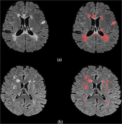 3D Compressed Convolutional Neural Network Differentiates Neuromyelitis Optical Spectrum Disorders From Multiple Sclerosis Using Automated White Matter Hyperintensities Segmentations